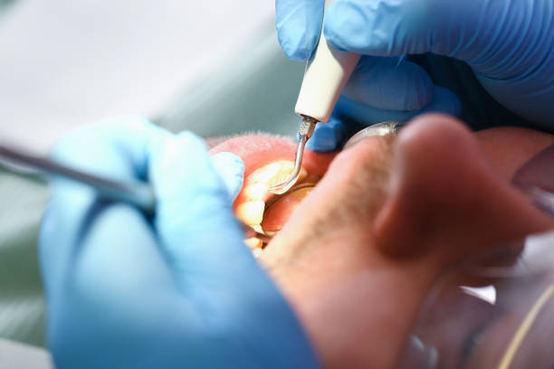 Best Emergency Wisdom Tooth Extraction in Fort Stockton, TX